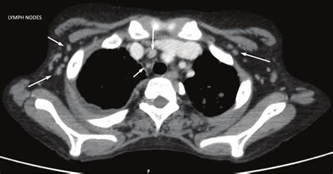 CT Scan Of The Chest Showing Hilar And Axillary Lymphadenopathy Arrows