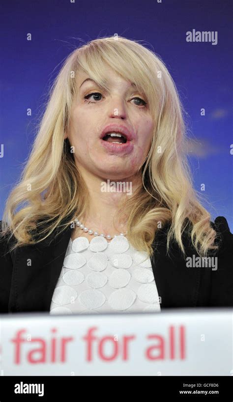 Former Model And Acid Attack Victim Katie Piper At A Press Conference