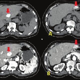 Follow Up Abdominal Ct Taken One Month After The Second Session Of