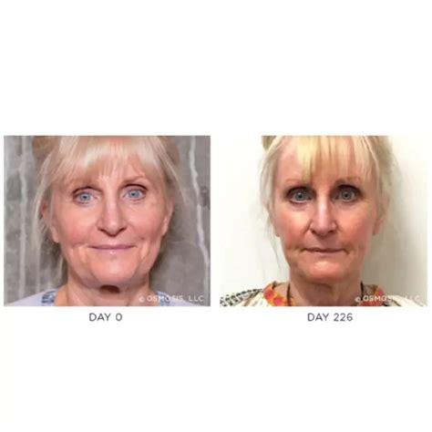 Osmosis Recovery Supplement: Restore Your Facial Volume - UK