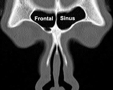 Why Do I Need A CT Scan For My Sinuses Dr Dharambir S Sethi