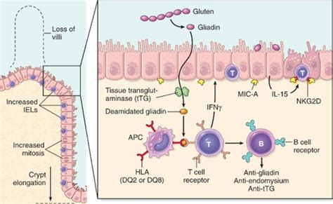 Celiac and Associated Disease Flashcards | Quizlet