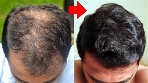 Manxidil Turbinado Funciona Crescimento De Barba E Cabelo