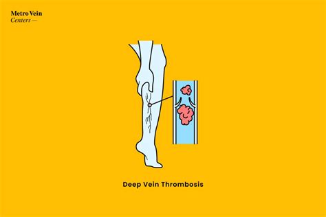 What Is Deep Vein Thrombosis Dvt Metro Vein Centers