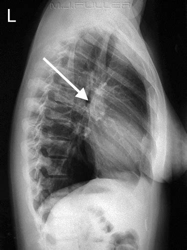 Interpreting A Chest X Ray Stepwards