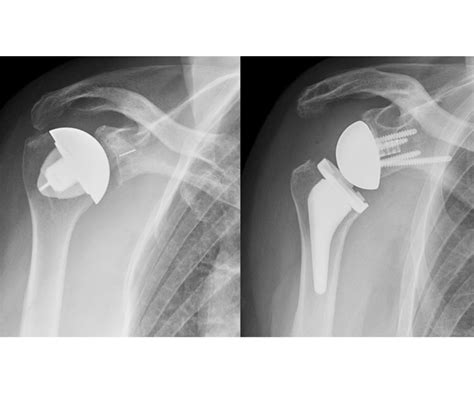 Reverse Total Shoulder Replacement In Dahisar Dr Anand Walavalkar