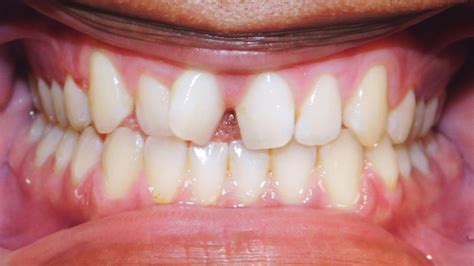 Clear Aligner Treatment Of Class Ii Cases Invisalign Bite Correction