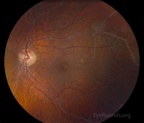 Retinal Vasculitis