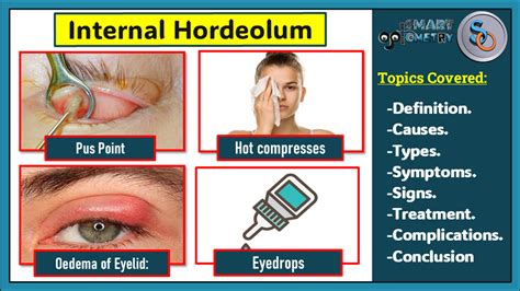 Internal Hordeolum Definition Causes Symptoms Signs Treatment