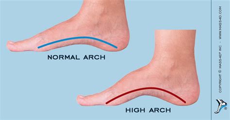 القدمين ذات الأقواس العالية Cavus Foot High Arched Foot الدكتور مازن