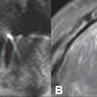 year-old woman with periapical cyst. Cropped panoramic radiograph shows ...