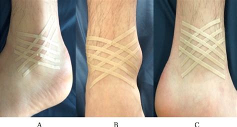 Figure 1 From Effects Of Spiral Taping On Proprioception In Subjects