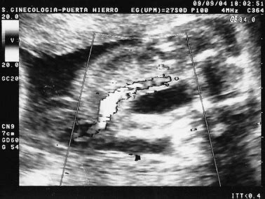 Perinatal Results Following The Prenatal Ultrasound Diagnosis Of Single