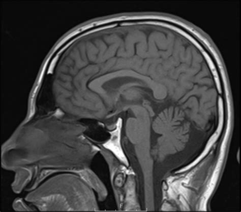 T1 Weighted Sagittal Turbo Spin Echo Tse Mri Of The Patient Download Scientific Diagram