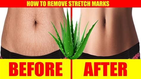 Stretch Marks Removal At Home How To Remove Stretch Marks After Pregnancy Natural Home