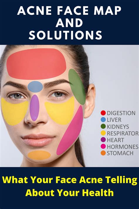 Acne Face Map And Solutions What Your Face Acne Trying To Tell You Face Acne Face Mapping