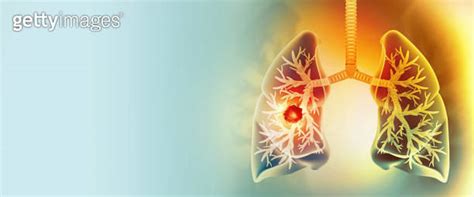 Medically Accurate Illustration Of Lung Cancer Showing Presence Of