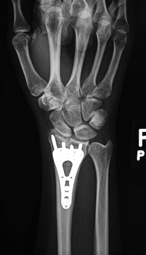 Fracture Fixation A Gallery