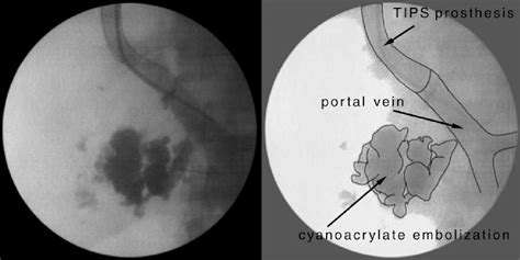 Figure From Association Of Transjugular Intrahepatic Portosystemic