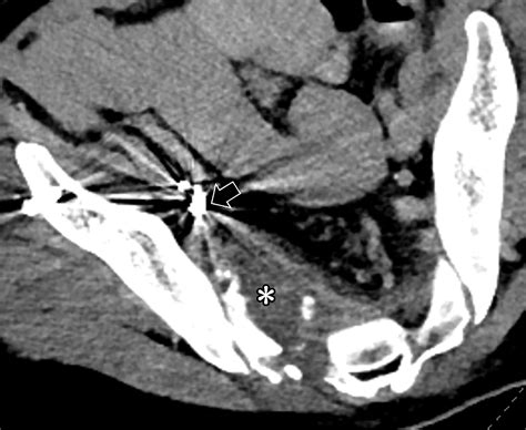 Ct Of Sacral Fractures Classification Systems And Management Radiographics