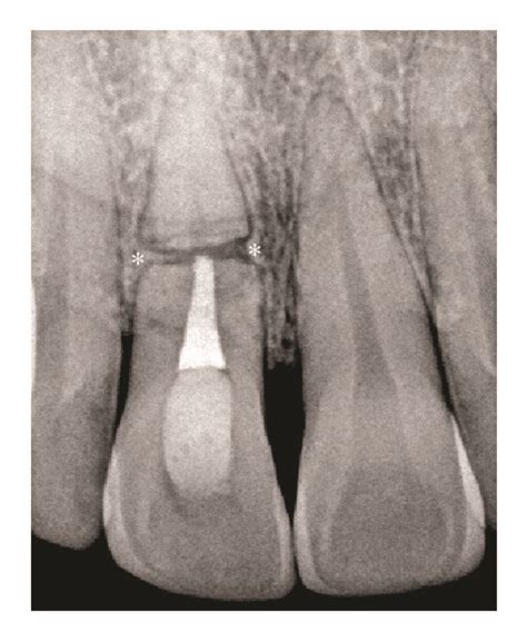 Digital Periapical Radiographs A Radiograph Immediately After Mta