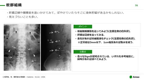 腹部単純x線腹部レントゲン どうやって使いますか？ Antaa Slide