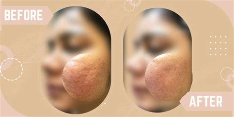 Open Pore Treatment In South Delhi Saket Skinqure