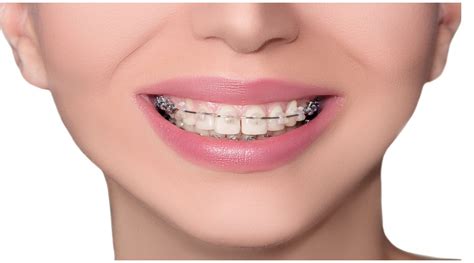 DENTAL RETENTION AFTER ORTHODONTIC TREATMENT Rossell Carol