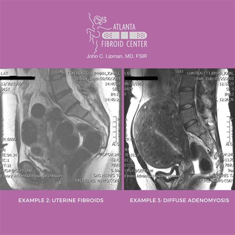 Adenomyosis Artofit