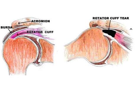 Rotator Cuff Tears Dr Doron Sher