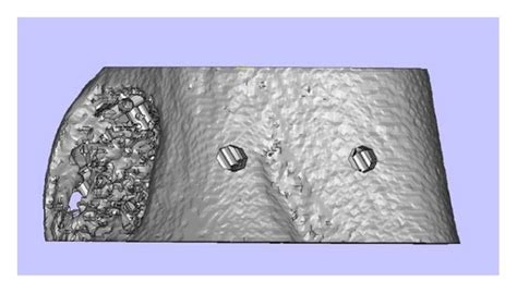 The Design Of Negative Mold For The Scaffolds Without And With Cortical