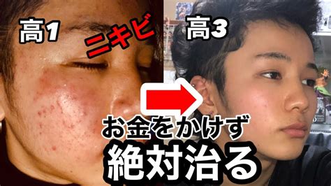 【絶対治る】思春期の大量にできたニキビを簡単に治した方法 Youtube