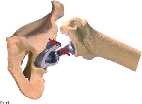 Pdf Impingement With Total Hip Replacement Semantic Scholar