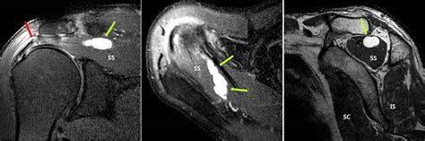 Supraspinatus Muscle Mri