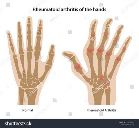 Rheumatoid Arthritis Humans Hands Silhouettes Healthy Stock Vector ...