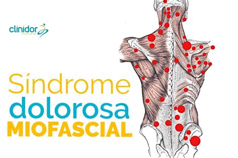 Síndrome dolorosa Miofascial Guia Saúde Cidades