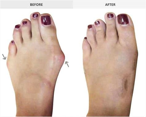 Bunion Surgery Before And After Gallery Bunion Institute La