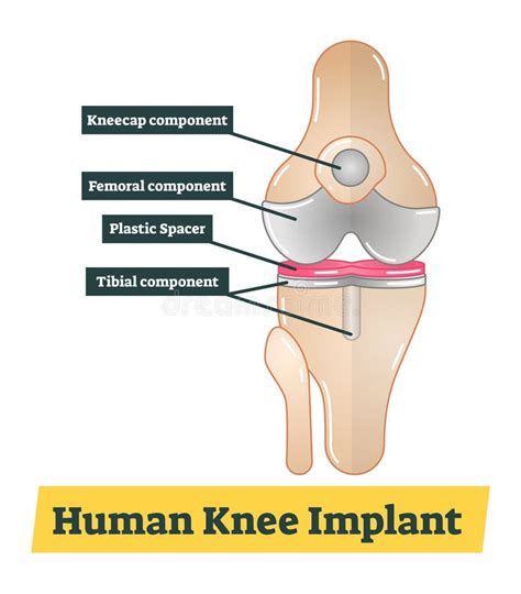 Menschliche Knie Implantatsillustration Vektor Abbildung Illustration