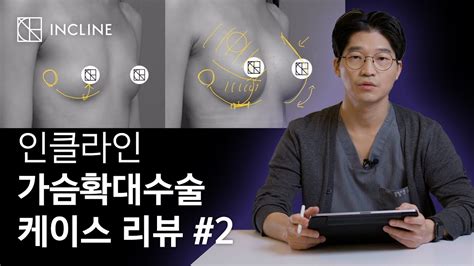 인클라인 가슴확대수술 케이스 리뷰 2 Youtube