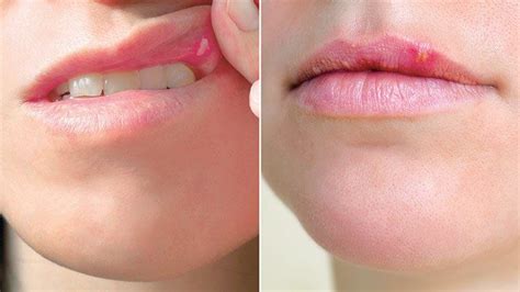 Cold Sores On Lips Early Stages