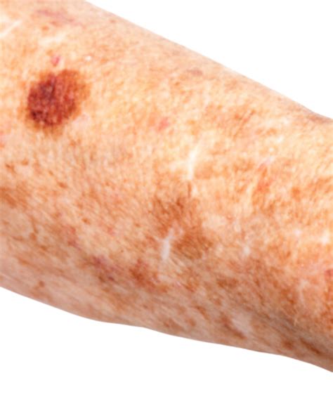 Actinic Keratosis Dermatologist Serving Ok Areas Southside Dermatology And Skin Cancer Surgery