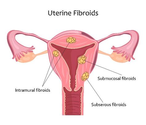 Ecco Medical Explaining Uterine Fibroids Causes Symptoms And Treatments