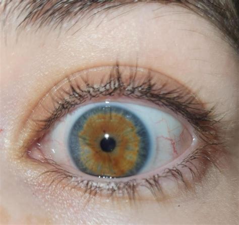 This Is Central Heterochromia Rwhatismyeyecolour