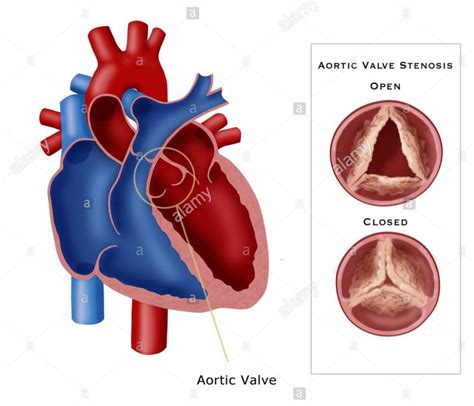 aortic valve disease