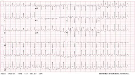 AV Nodal Reentrant Tachycardia (AVNRT) ECG (Example 2) | Learn the Heart