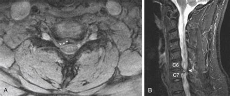 Anterior Cervical Diskectomy And Fusion Clinical Tree