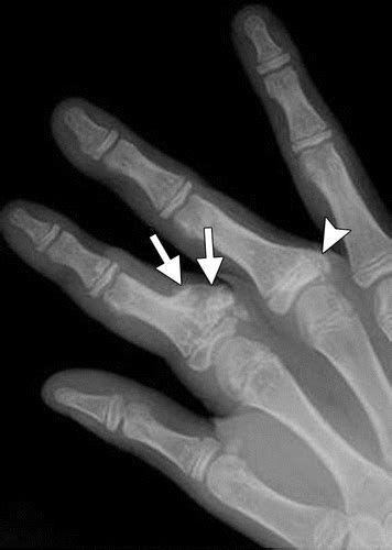 Malignant Tumors Of The Hand