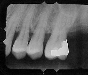 radiographic film faults Flashcards | Quizlet