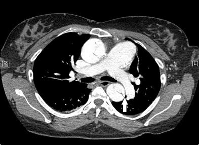 Computed Tomography Imaging in Aortic Dissection - The Western Journal ...