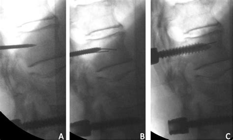 Outcomes Of Percutaneous Pedicle Screw Fixation For Spinal Trauma And